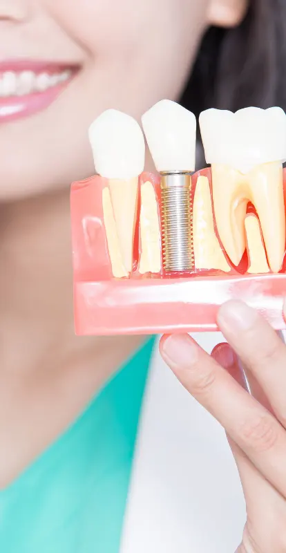 Cuidados post implante dental: Guía completa para una recuperación sin complicaciones