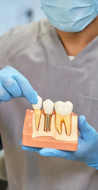 Implantes dentales: ¿Cuándo son la mejor opción y cómo preparar tu boca?