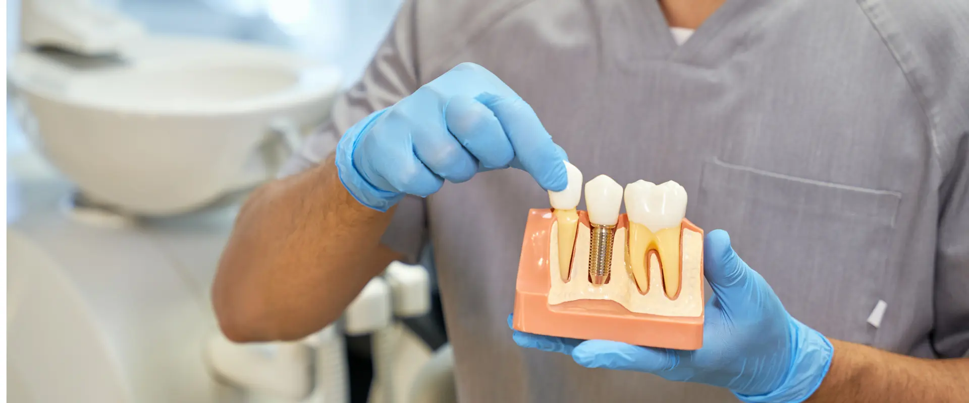 Implantes dentales: ¿Cuándo son la mejor opción y cómo preparar tu boca?