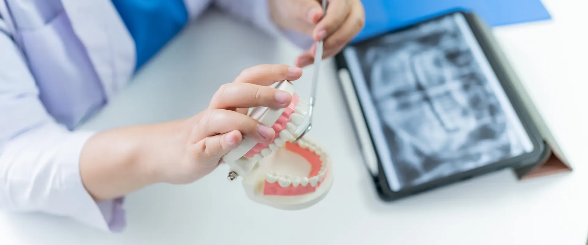 Injerto óseo para implantes: cuándo se indica, técnicas y recuperación